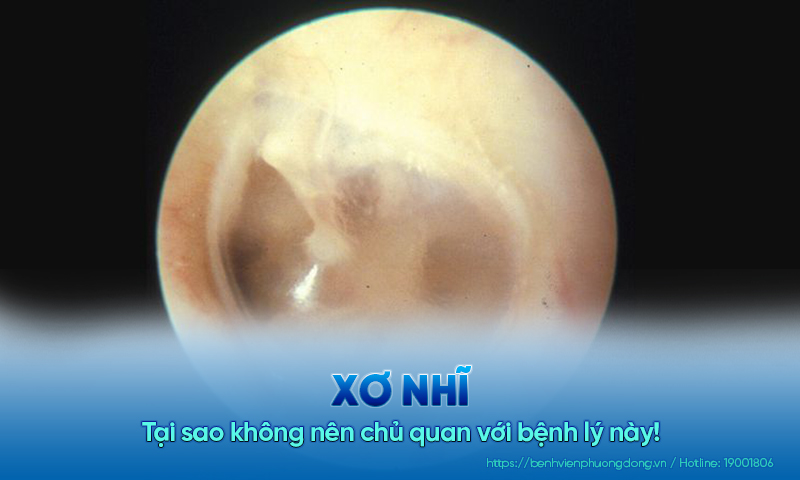 Tại sao không nên chủ quan với tình trạng xơ nhĩ ?