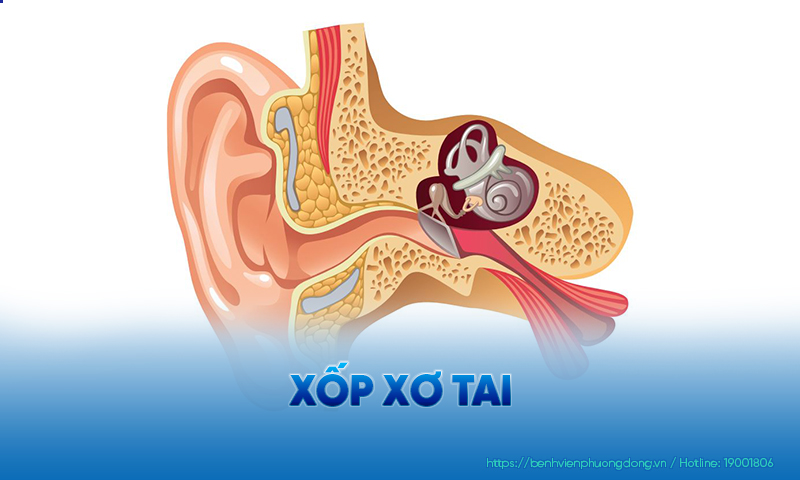 Xốp xơ tai là nguyên nhân khiến không ít bệnh nhân nghe kém