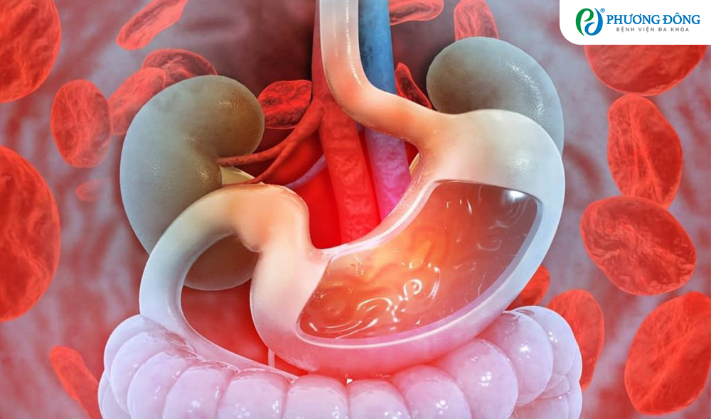 Xuất huyết tiêu hóa do loét dạ dày: Khi nào là dấu hiệu nguy hiểm