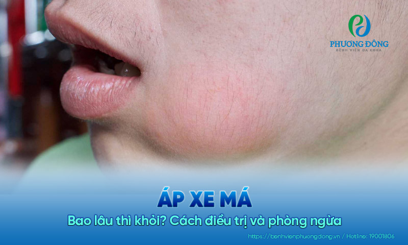Áp xe má bao lâu thì khỏi? Cách điều trị và phòng ngừa