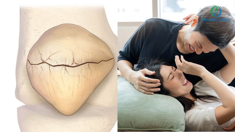 Nên kiêng quan hệ trong thời gian đầu gãy xương bánh chè