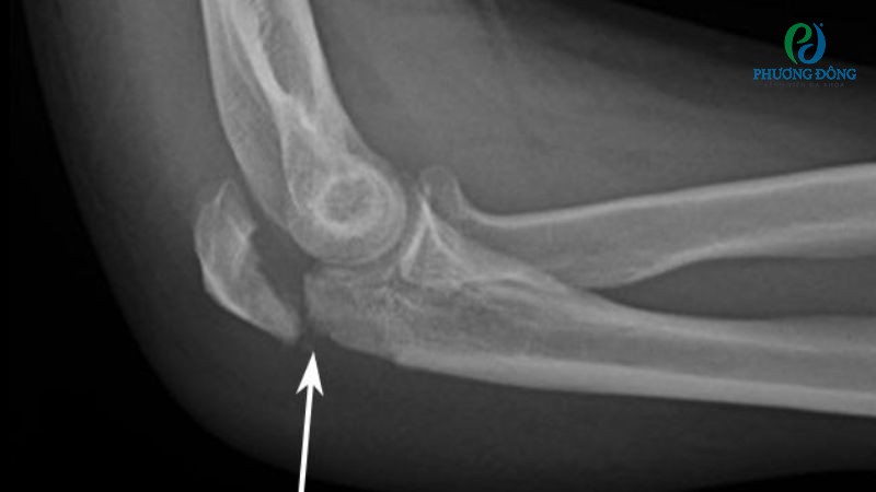 Rạn xương khuỷu tay thường được bó bột cố định trong 3 - 6 tuần