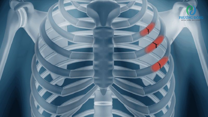 Các cách điều trị rạn xương sườn