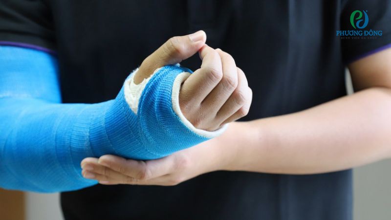 Rạn xương tay bao lâu thì khỏi? Thời gian lành xương vào khoảng 4 - 6 tuần