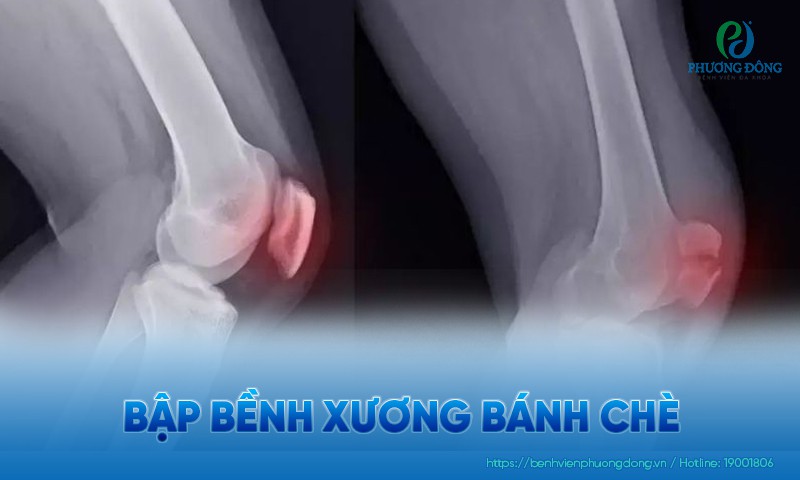 Bập bềnh xương bánh chè: Dấu hiệu, nguyên  nhân và hướng điều trị