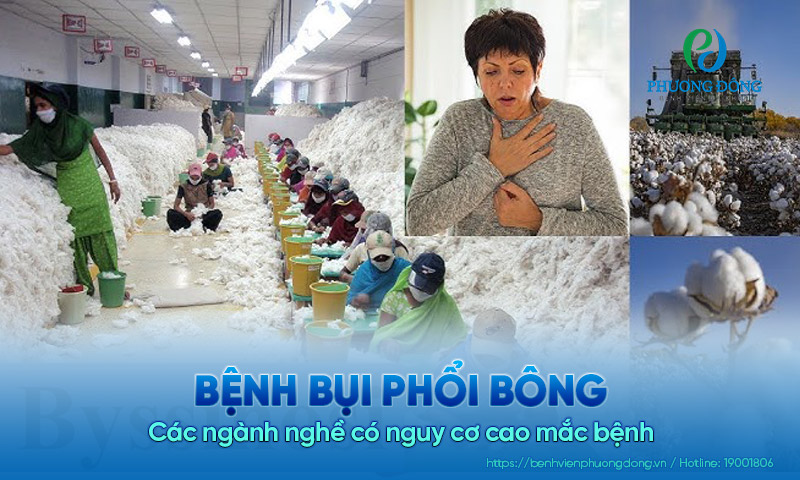 Bệnh bụi phổi bông​ và các ngành nghề có nguy cơ cao mắc bệnh