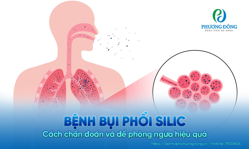 Bệnh bụi phổi silic là gì? Cách chẩn đoán và để phòng ngừa hiệu quả