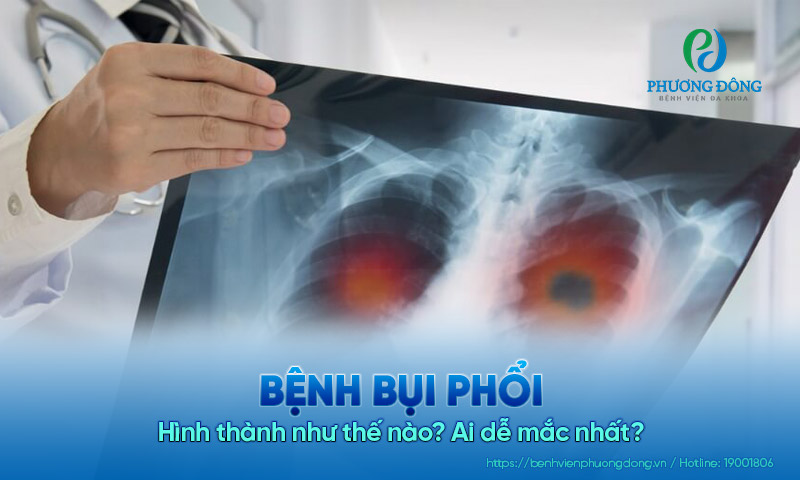 Bệnh bụi phổi hình thành như thế nào? Ai dễ mắc nhất?