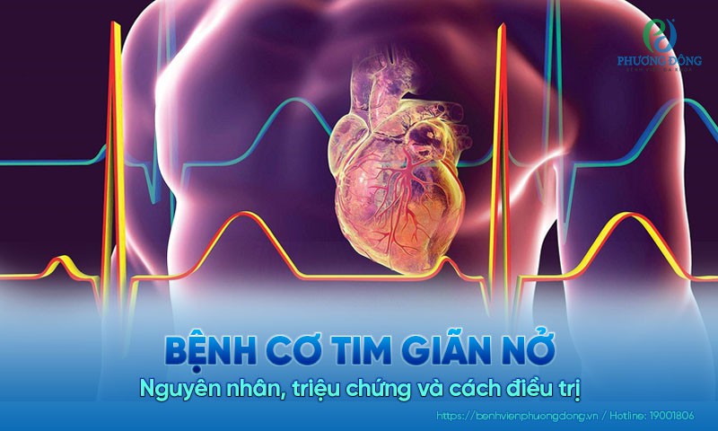Bệnh cơ tim giãn nở: Nguyên nhân, triệu chứng và cách điều trị