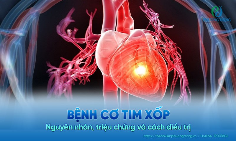 Bệnh cơ tim xốp: Nguyên nhân, triệu chứng và cách điều trị