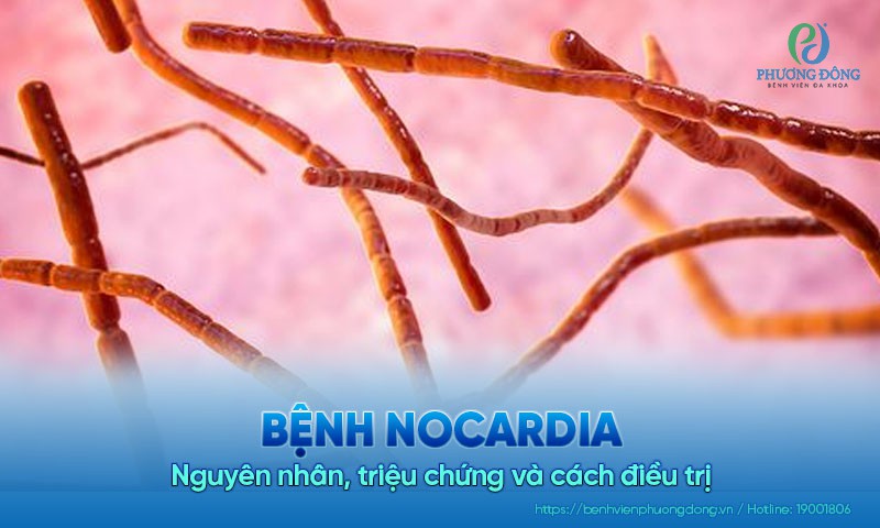 Bệnh Nocardia: Nguyên nhân, triệu chứng và cách điều trị