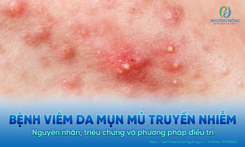 Bệnh viêm da mụn mủ truyền nhiễm: Nguyên nhân, triệu chứng và cách điều trị