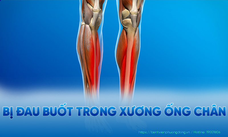Các cơn đau buốt trong xương ống đồng có thể diễn ra ở 1 hoặc cả 2 chân