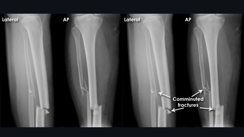 Bạn sẽ được cân nhắc chụp X Quang để đánh giá chuyên sâu về tình trạng xương