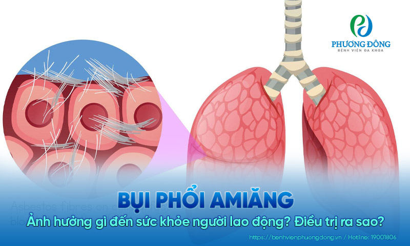 Bụi phổi amiăng ảnh hưởng gì đến sức khỏe người lao động? Điều trị ra sao?