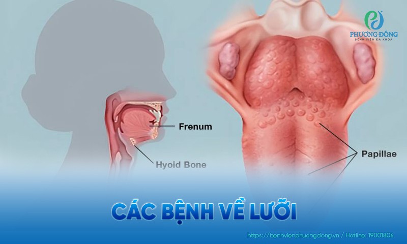 Các bệnh về lưỡi thường gặp và cách điều trị