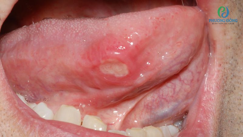 Phân loại cấp độ loét lưỡi Apthae