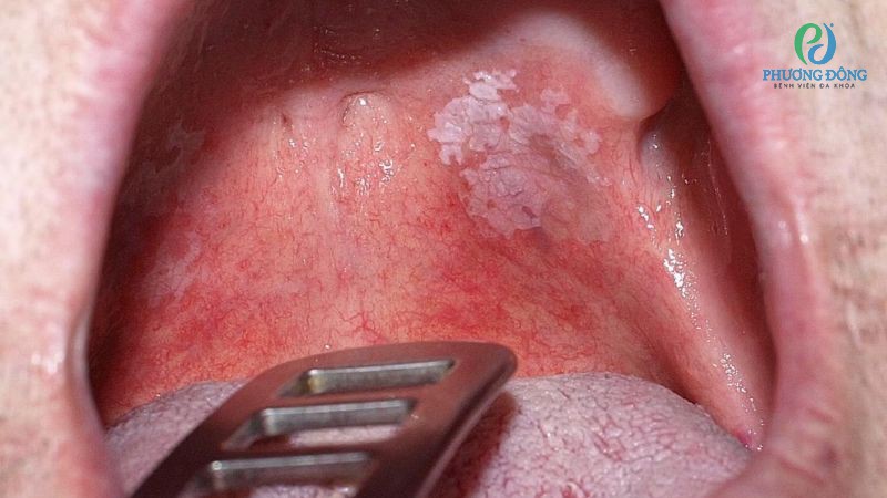 Bạch sản là tình trạng xuất hiện các mảng trắng dày trên nướu, lưỡi