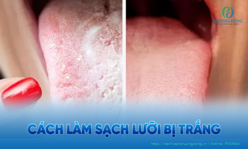 Cách làm sạch lưỡi bị trắng và những lưu ý khi vệ sinh