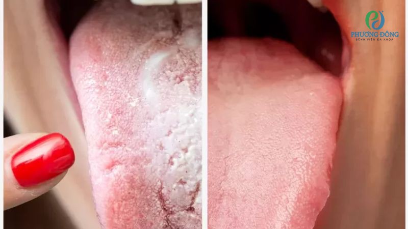 Những lý do nên làm sạch lưỡi bị trắng