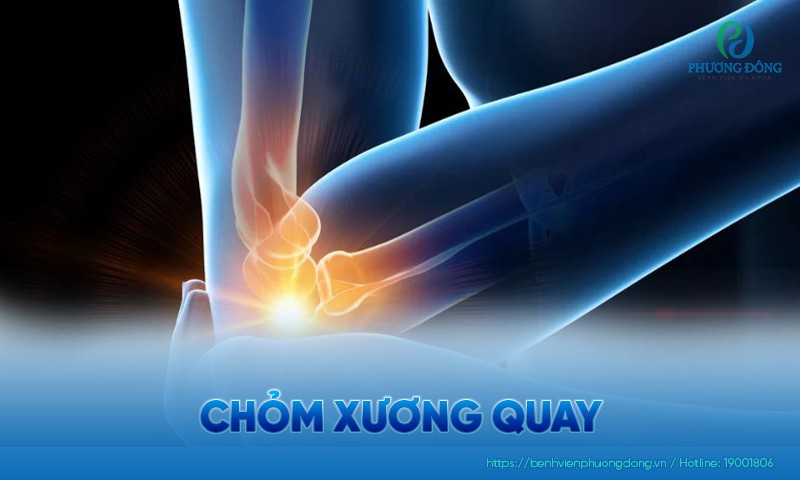 Chỏm xương quay bị gãy cần làm gì? Dấu hiệu và nguyên nhân