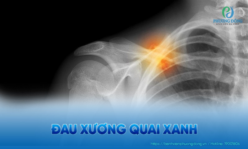 Đau xương quai xanh: Nguyên nhân, triệu chứng và hướng điều trị