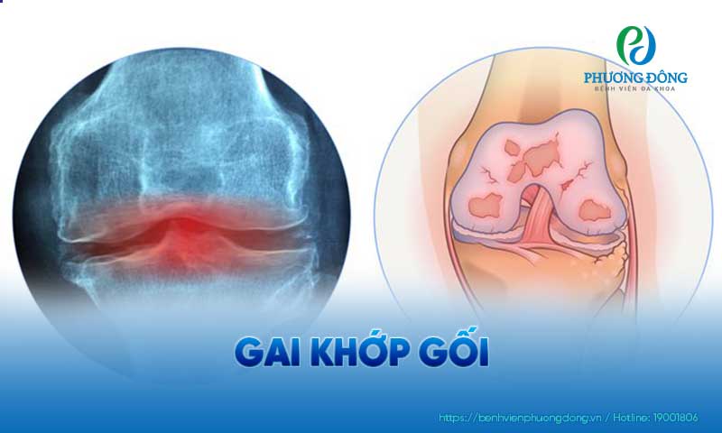 Gai xương khớp gối dưới hình chụp X Quang