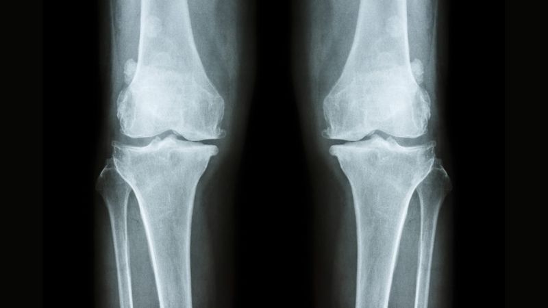 X Quang có thể được chỉ định để hỗ trợ chẩn đoán