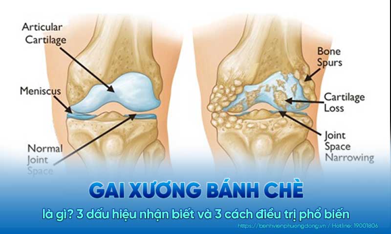 Gai xương bánh chè là gì? 3 dấu hiệu nhận biết và 3 cách điều trị phổ biến