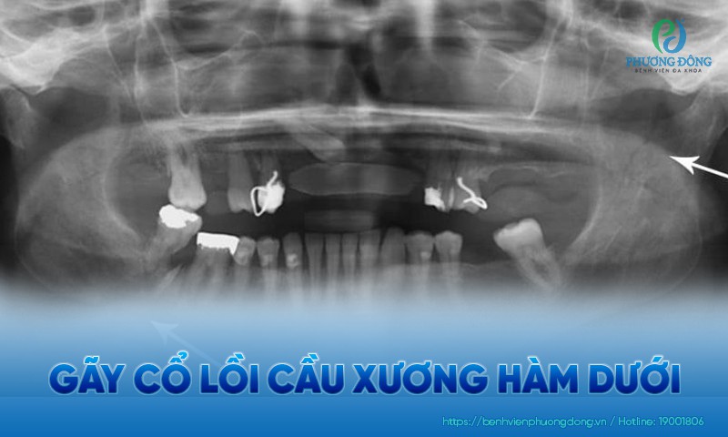 Gãy cổ lồi cầu xương hàm dưới: Phân loại, triệu chứng và điều trị