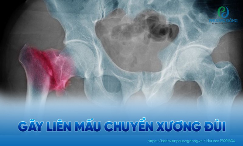 Gãy liên mấu chuyển xương đùi: Nguyên nhân, triệu chứng và điều trị