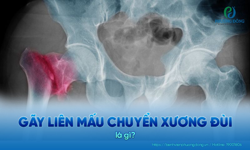 Hình ảnh gãy liên mấu chuyển xương đùi