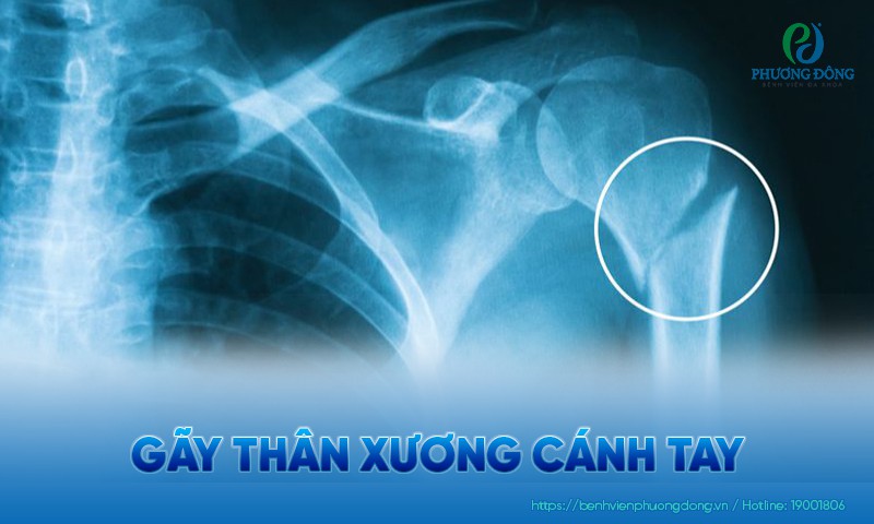 Gãy thân xương cánh tay: Triệu chứng, nguyên nhân và hướng điều trị
