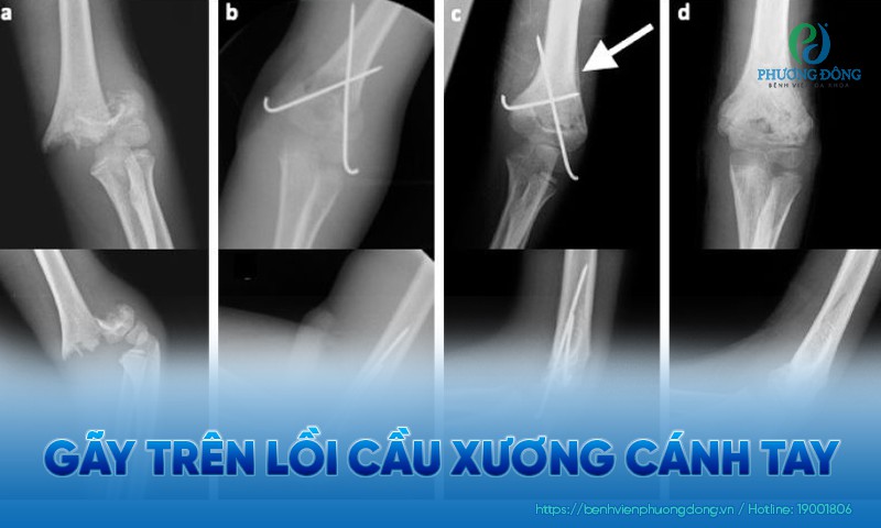 Gãy trên lồi cầu xương cánh tay: Triệu chứng, phân loại và hướng điều trị