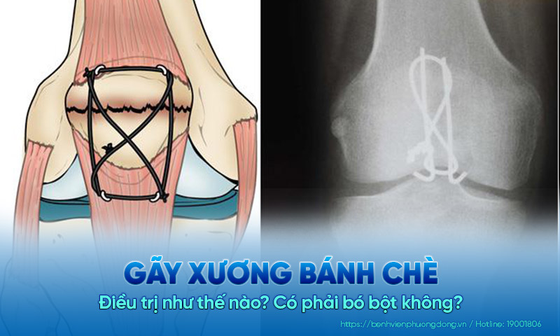 Điều trị gãy xương bánh chè như thế nào? Có phải bó bột không?