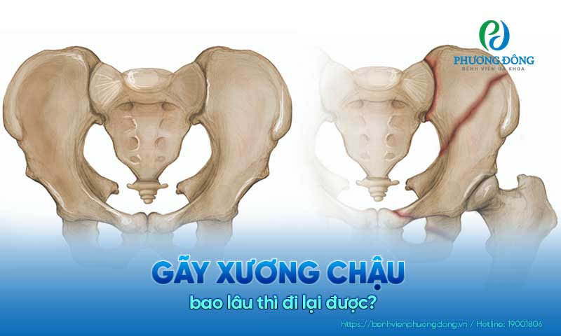 Gãy xương chậu bao lâu thì đi lại được?