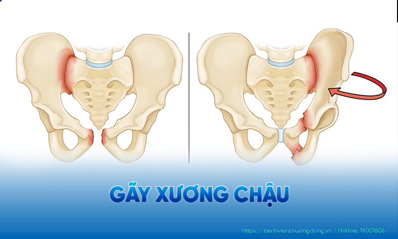 Gãy xương chậu có hay xảy ra không? 3 nguyên nhân gây gãy xương phổ biến