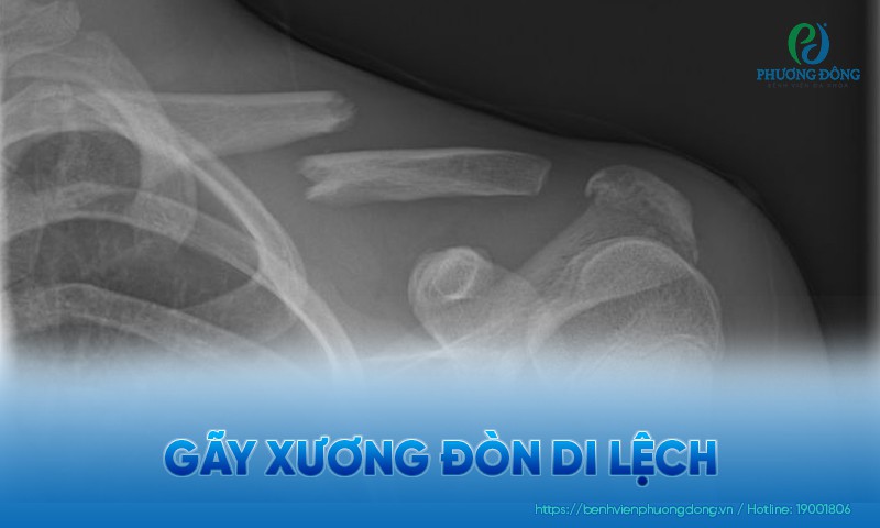 Gãy xương đòn di lệch: Triệu chứng, phân loại và điều trị