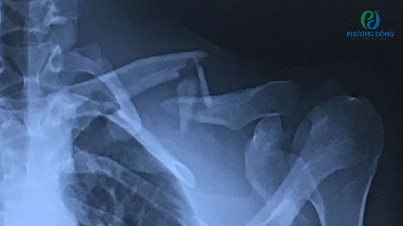 Phân loại các dạng di lệch trong gãy xương đòn