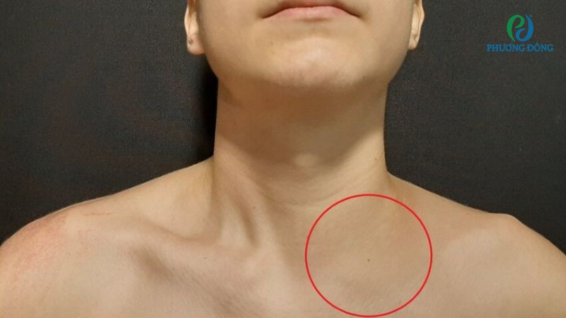 Những biểu hiện lâm sàng khi bị gãy xương quai xanh di lệch