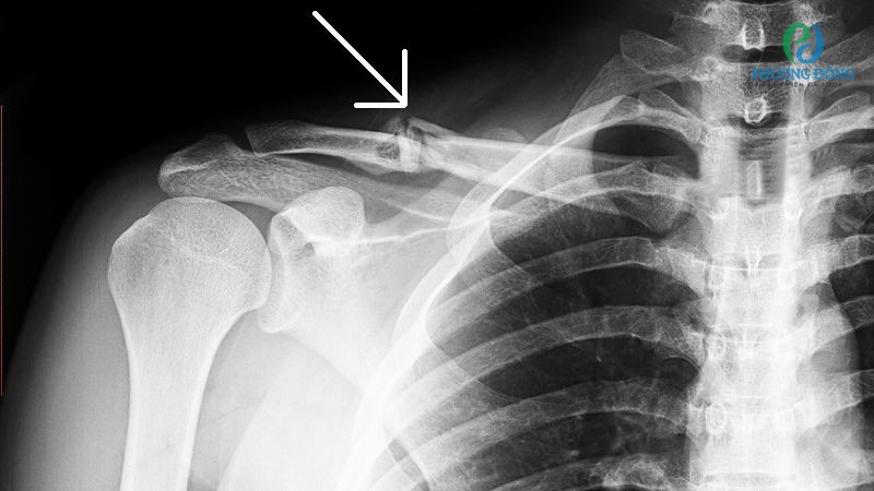 Nhóm biến chứng nguy hiểm khi xương quai xanh gãy di lệch