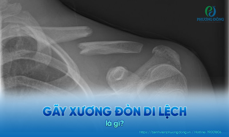 Gãy xương đòn di lệch là sự di lệch khỏi trục ban đầu của xương