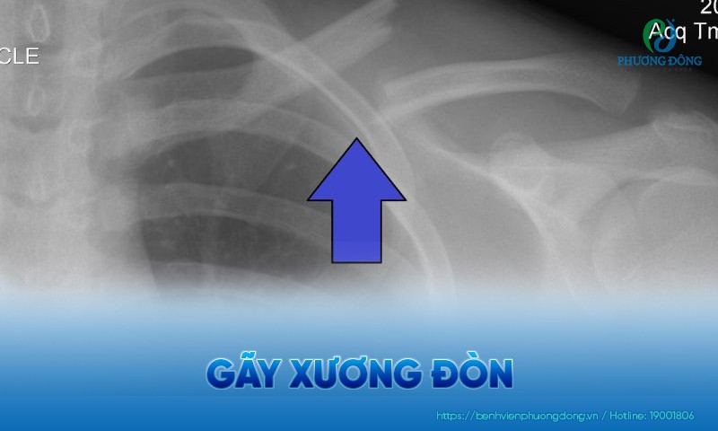 Gãy xương đòn: Nguyên nhân, triệu chứng và hướng điều trị