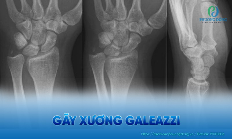 Gãy xương galeazzi: Nguyên nhân, triệu chứng và điều trị