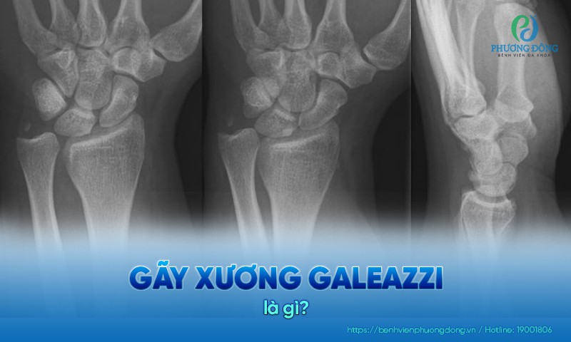 Gãy xương Galeazzi là dạng chấn thương cẳng tay phức tạp