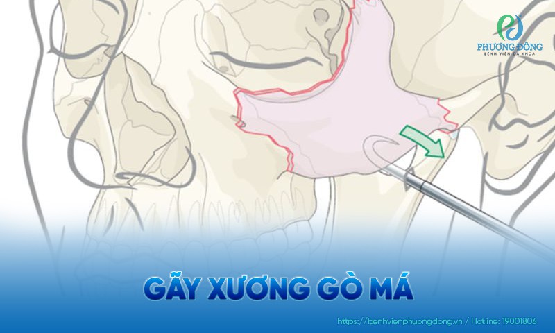 Gãy xương gò má: Triệu chứng, điều trị và cách chăm sóc