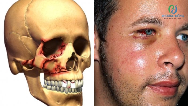 Biểu hiện nhận biết tình trạng xương gò má bị gãy