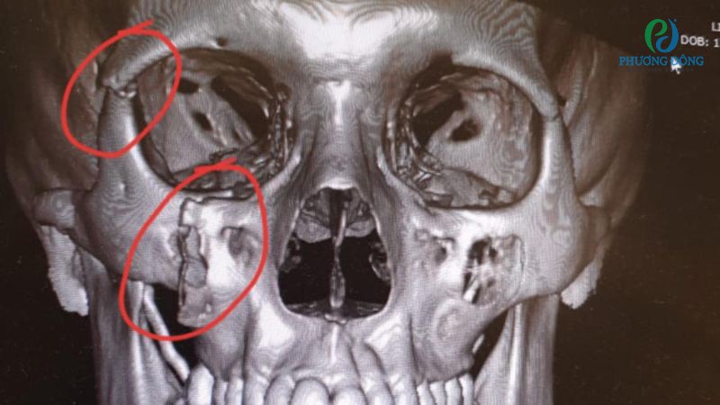 Can thiệp phẫu thuật với tình trạng gãy xương nặng