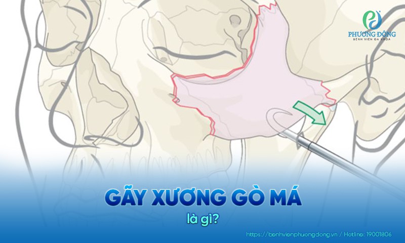 Gãy xương gò má là một chấn thương vùng hàm mặt