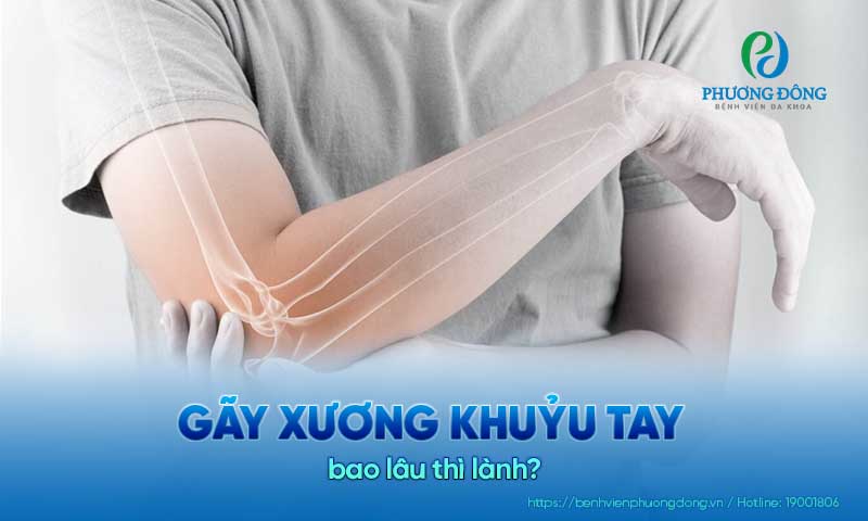 Gãy xương khuỷu tay bao lâu thì lành?